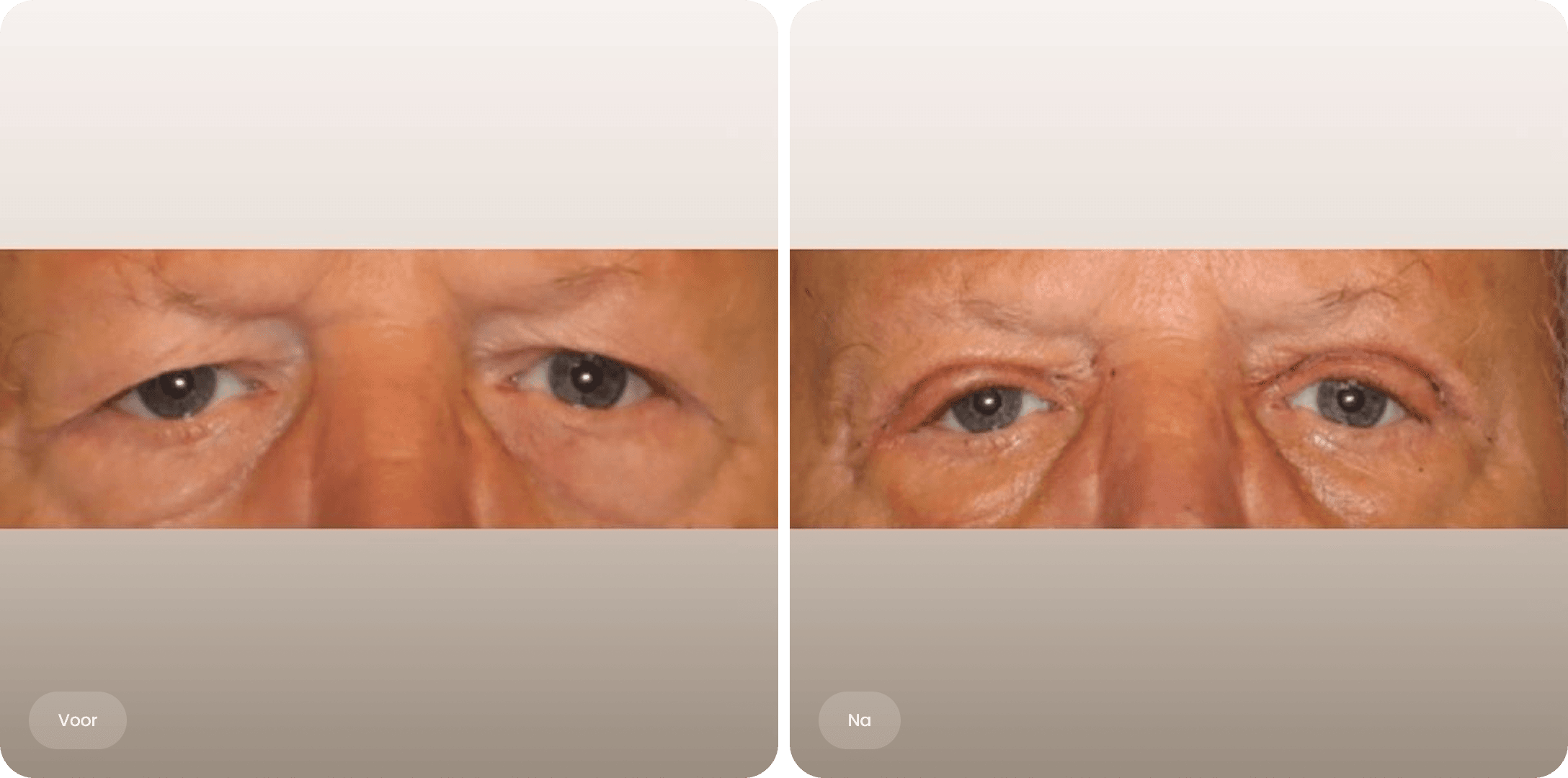 Voor en na foto van een bovenooglidcorrectie bij The Body Clinic