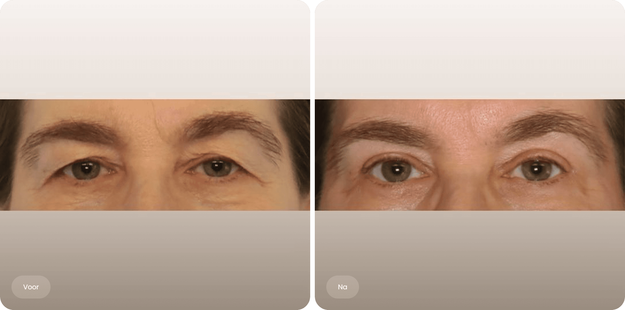 Voor en na foto van een bovenooglidcorrectie bij The Body Clinic