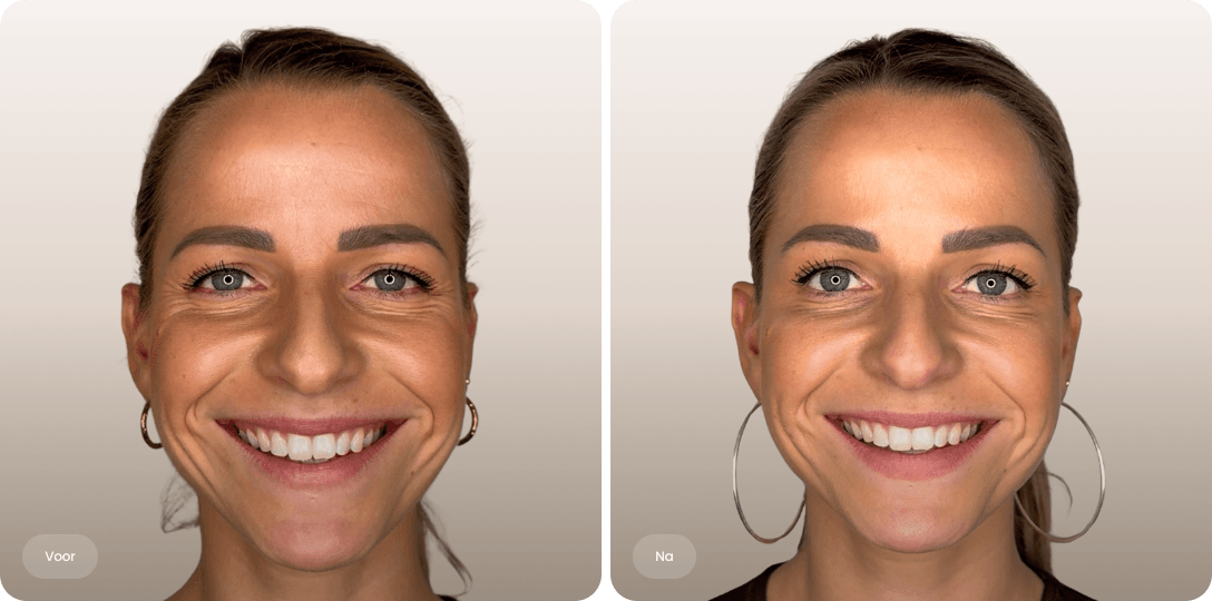 Voor en na foto van botoxbehandeling kraaienpootjes bij een vrouw voor verzachte lachlijntjes bij The Body Clinic