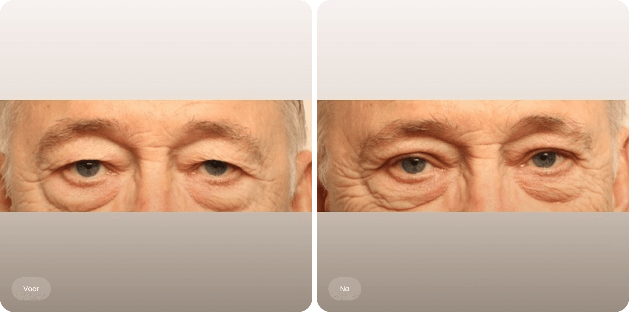 Voor en na foto van een bovenooglidcorrectie bij The Body Clinic