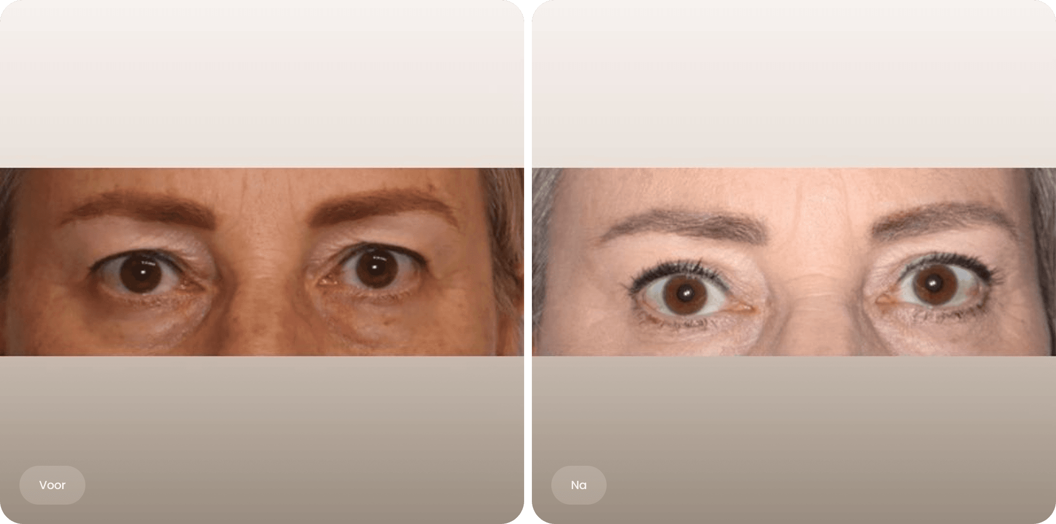 Voor en na foto van een bovenooglidcorrectie bij The Body Clinic