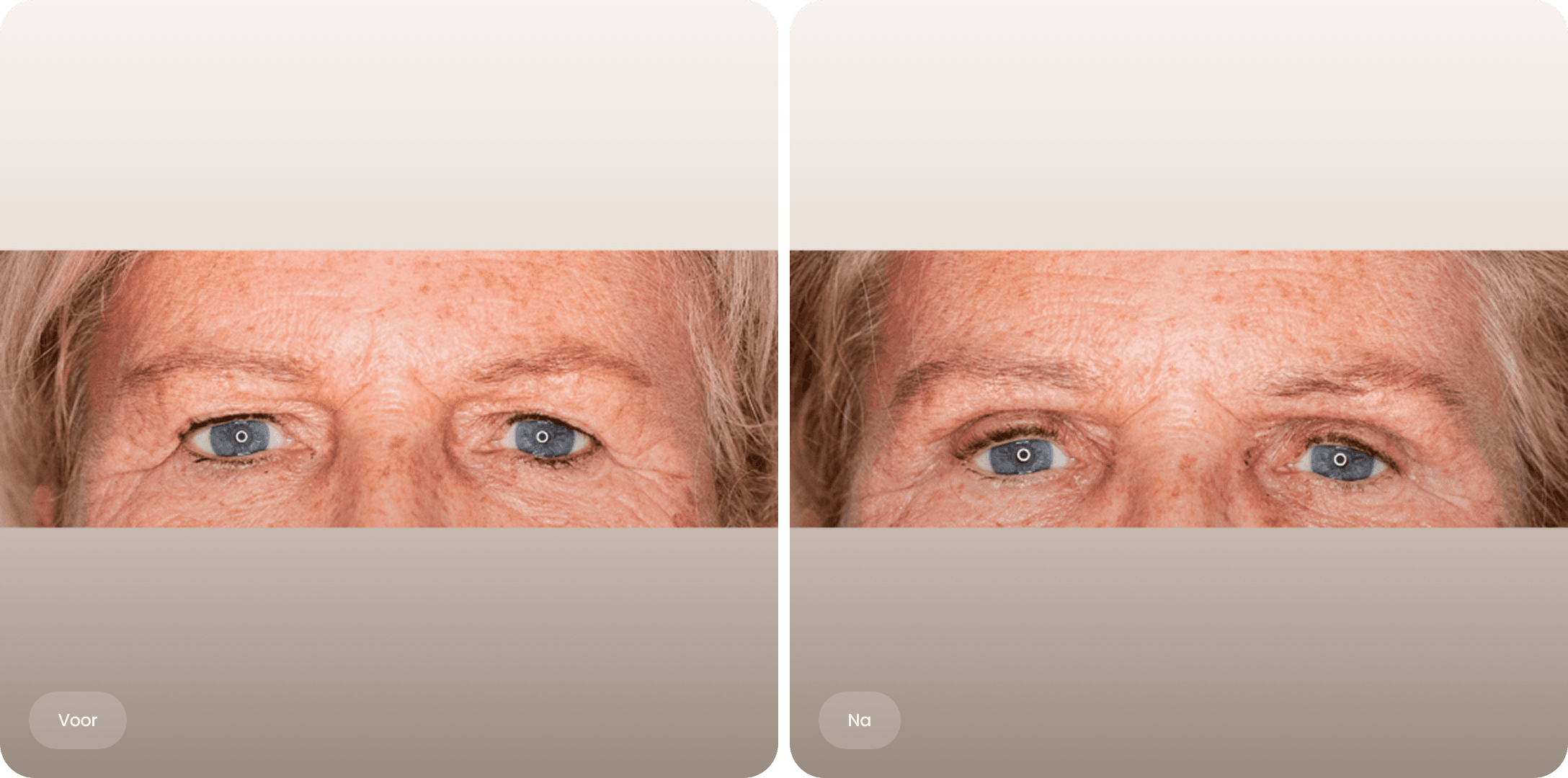 Voor en na foto van bovenooglidcorrectie met verjongende oogopslag bij The Body Clinic