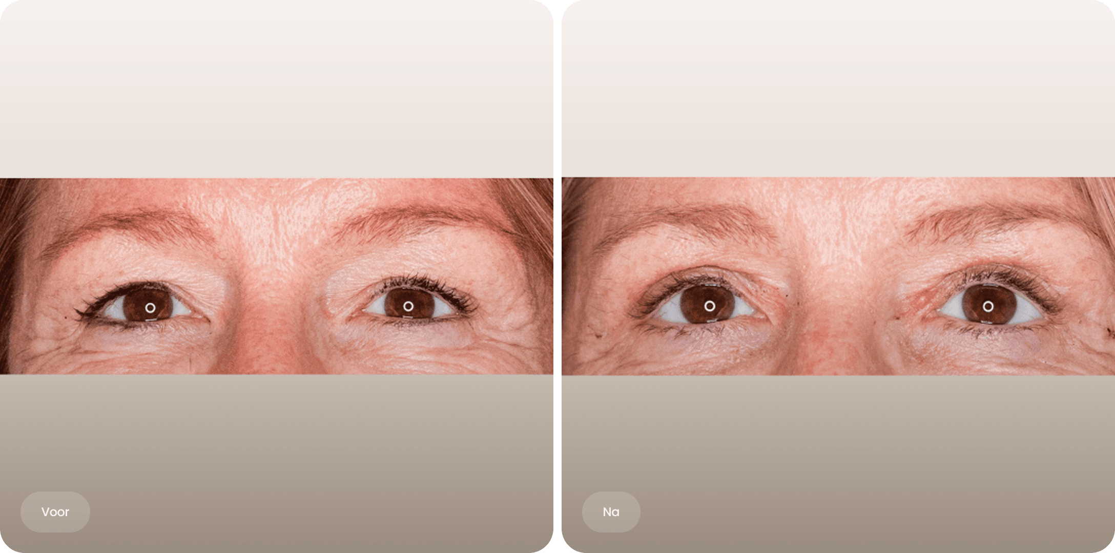 Voor en na foto van bovenooglidcorrectie met frissere oogopslag bij The Body Clinic