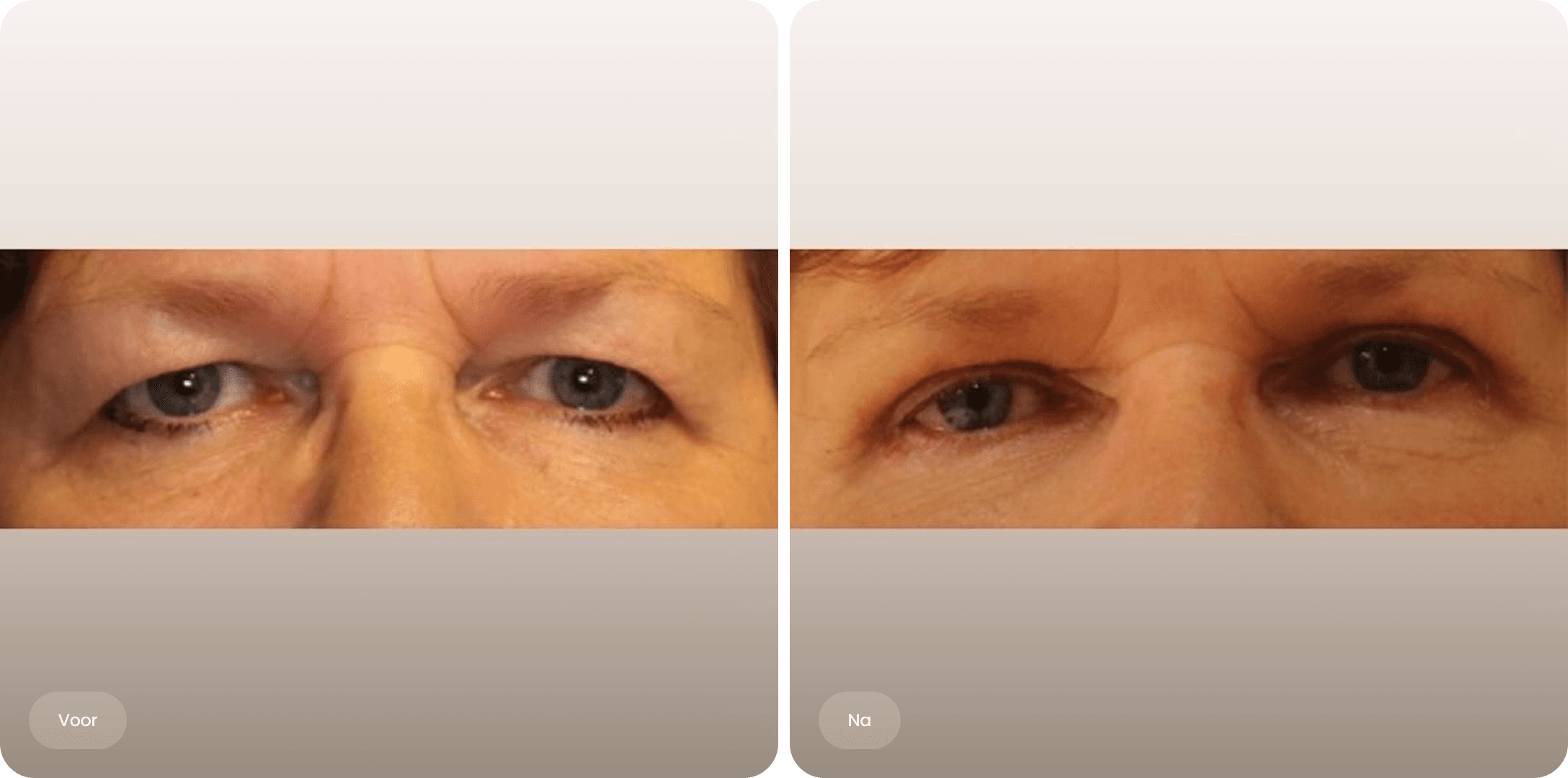 Voor en na foto van een bovenooglidcorrectie bij The Body Clinic