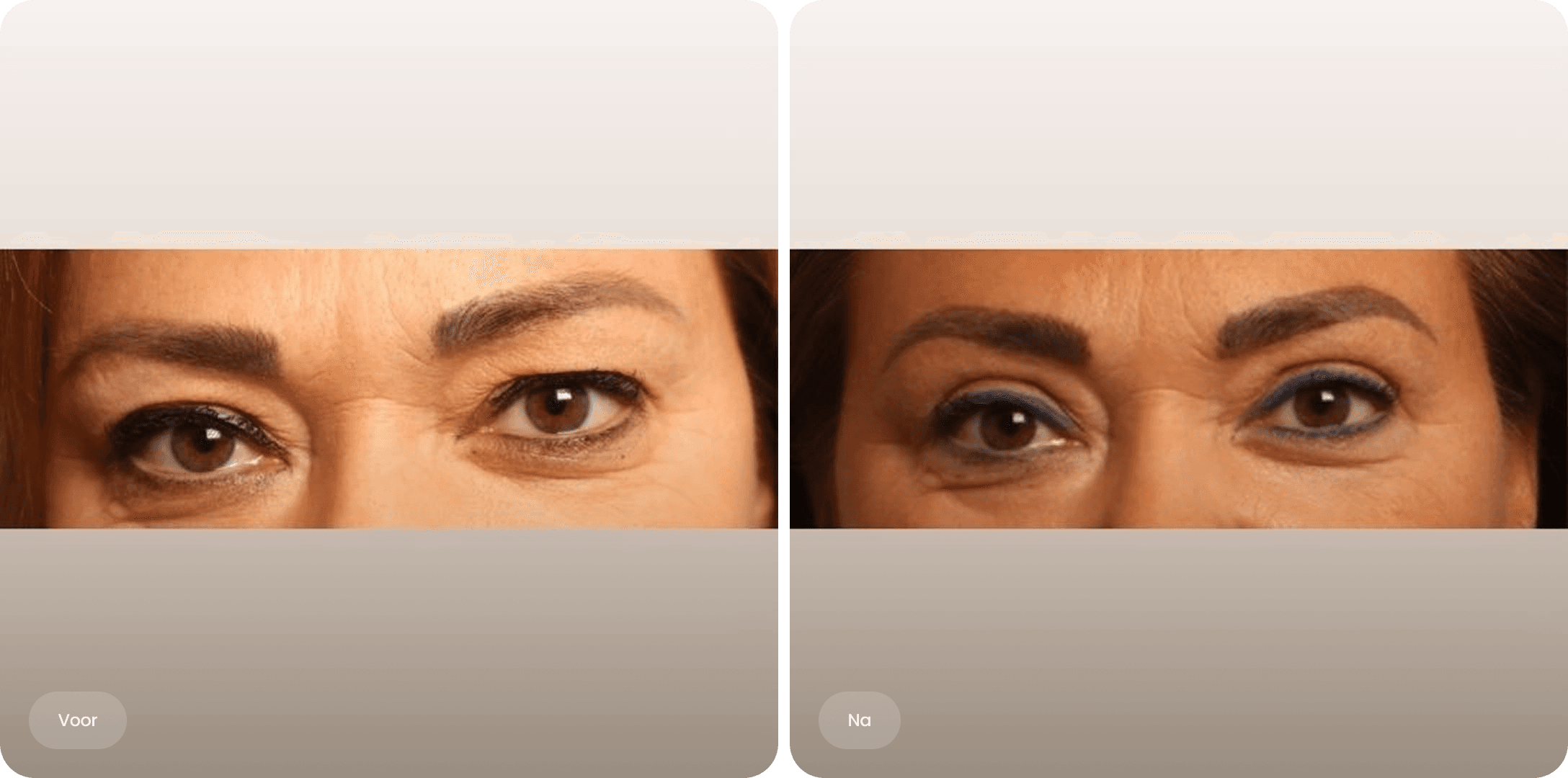 Voor en na foto van een bovenooglidcorrectie bij The Body Clinic