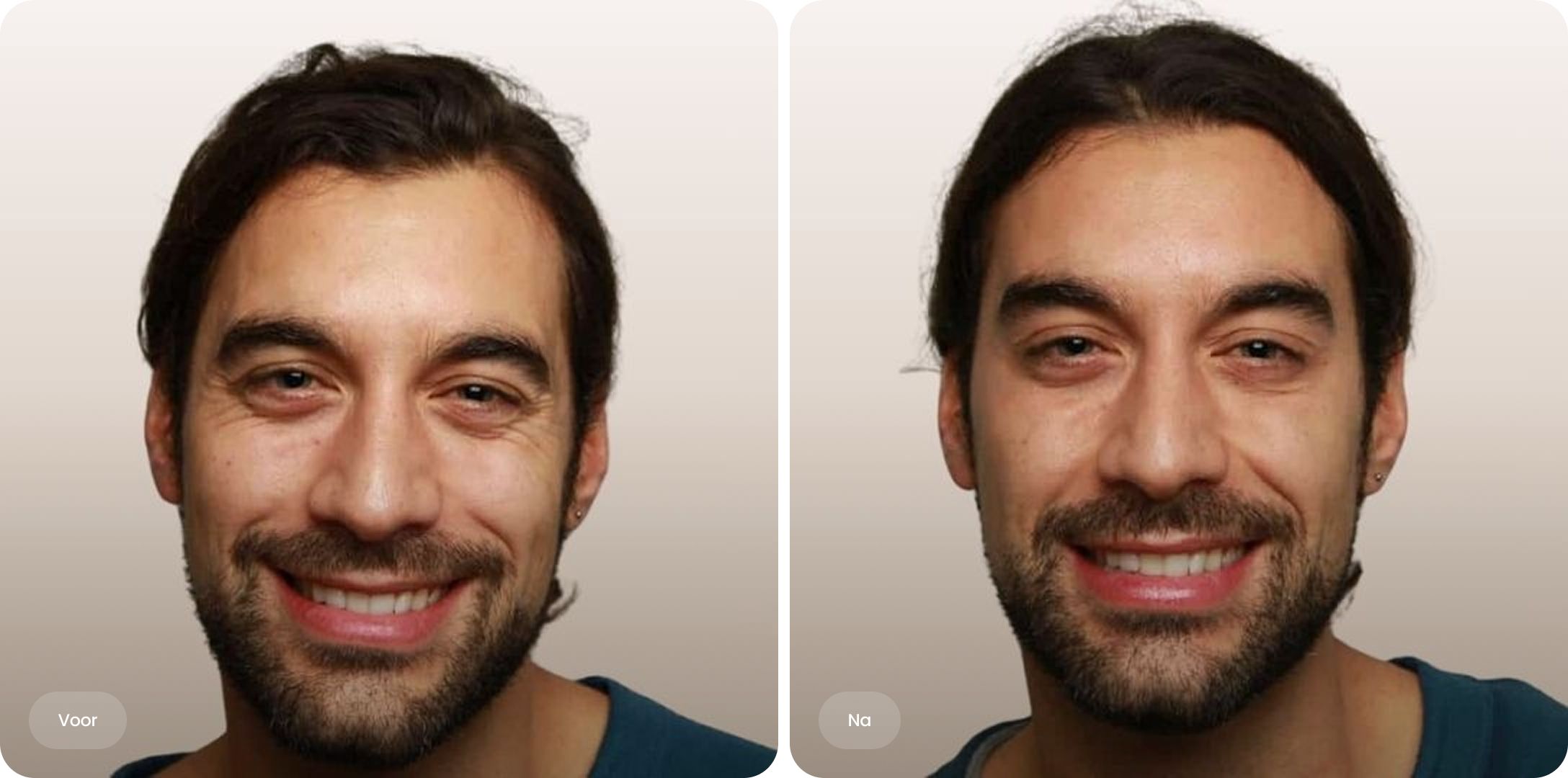 Voor-en-na foto van kraaienpootjes behandeling met botox bij The Body Clinic