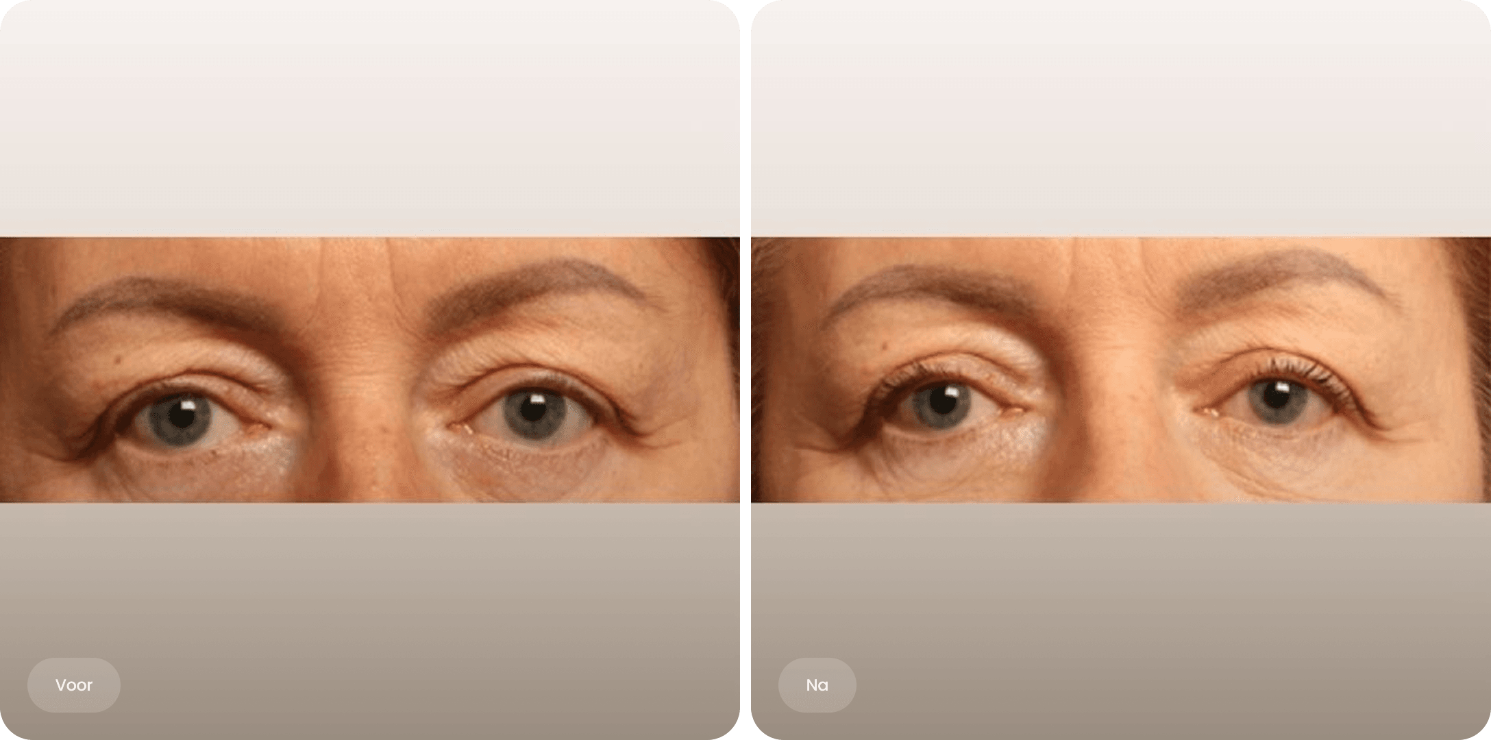 Voor en na foto van een bovenooglidcorrectie bij The Body Clinic