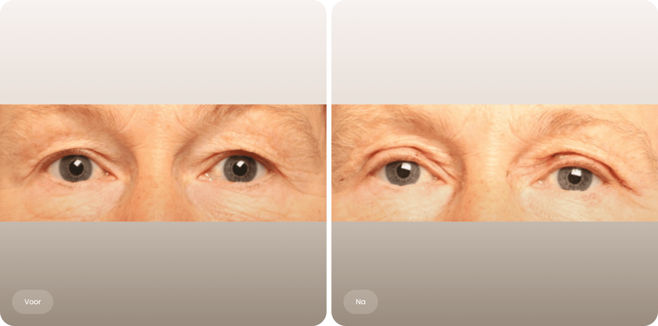 Voor en na foto van een bovenooglidcorrectie bij The Body Clinic