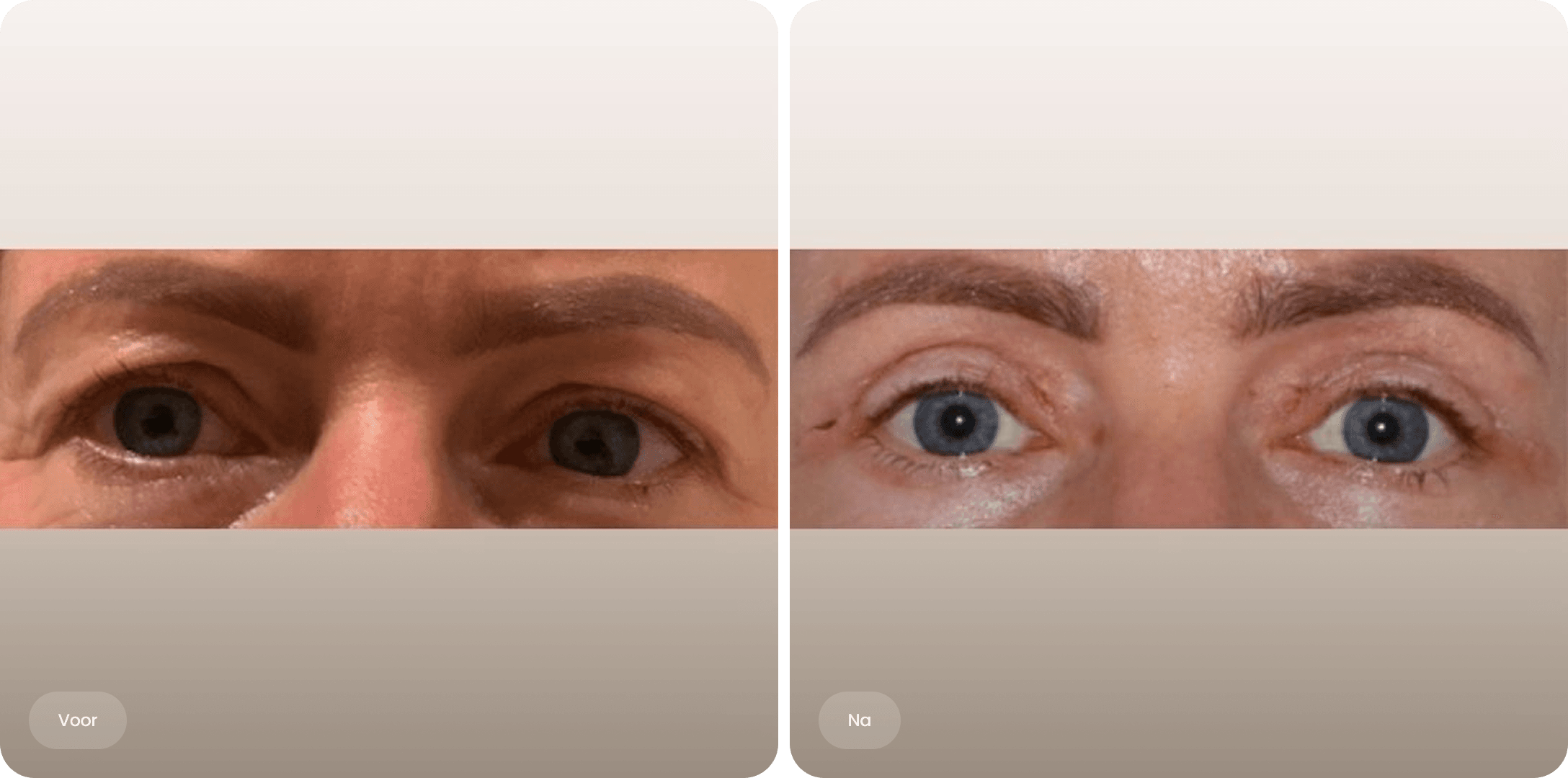 Voor en na foto van een bovenooglidcorrectie bij The Body Clinic