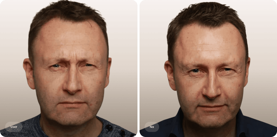 Voor en na foto van botoxbehandeling fronsrimpel bij een man voor een rustiger voorhoofd bij The Body Clinic