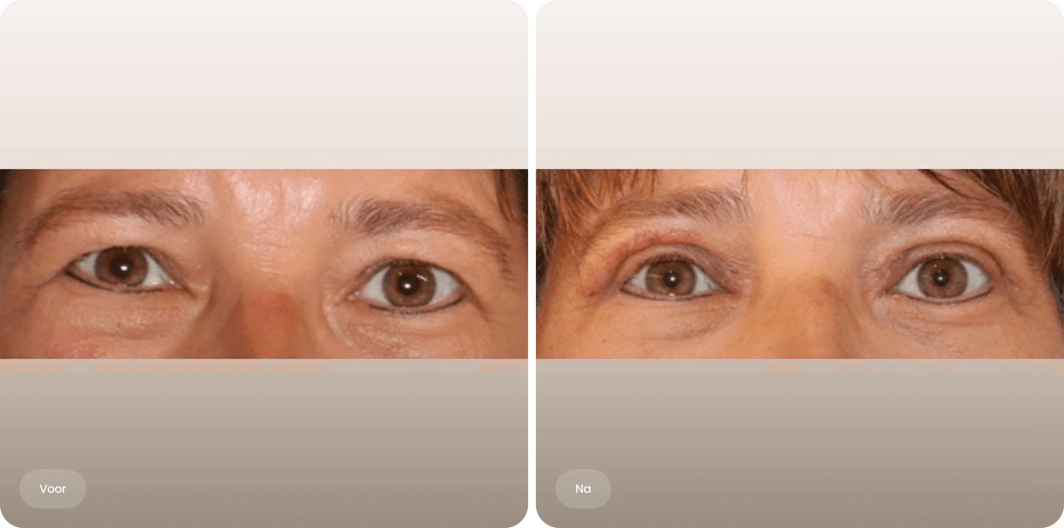 Voor en na foto van een bovenooglidcorrectie bij The Body Clinic