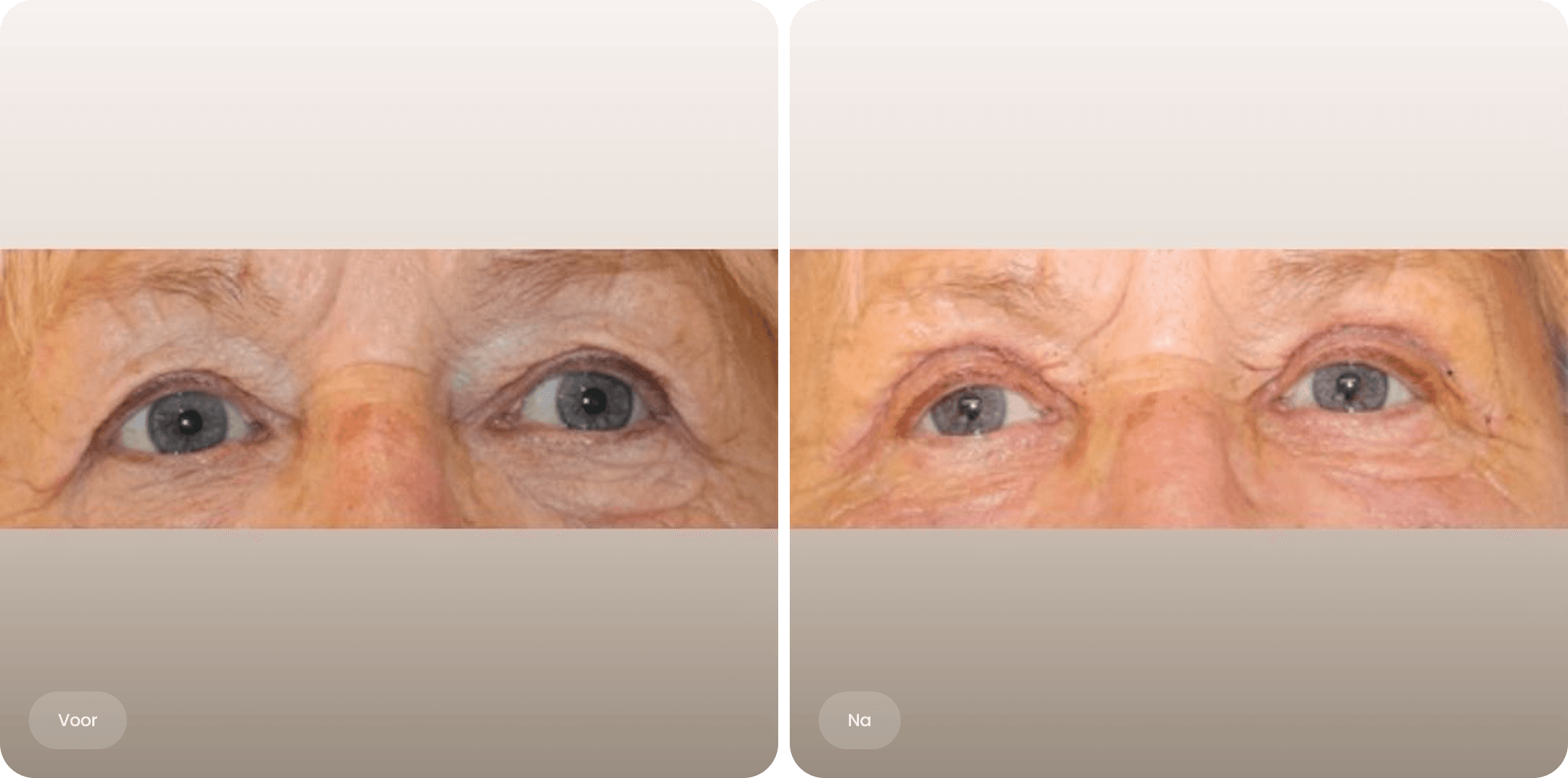 Voor en na foto van een bovenooglidcorrectie bij The Body Clinic