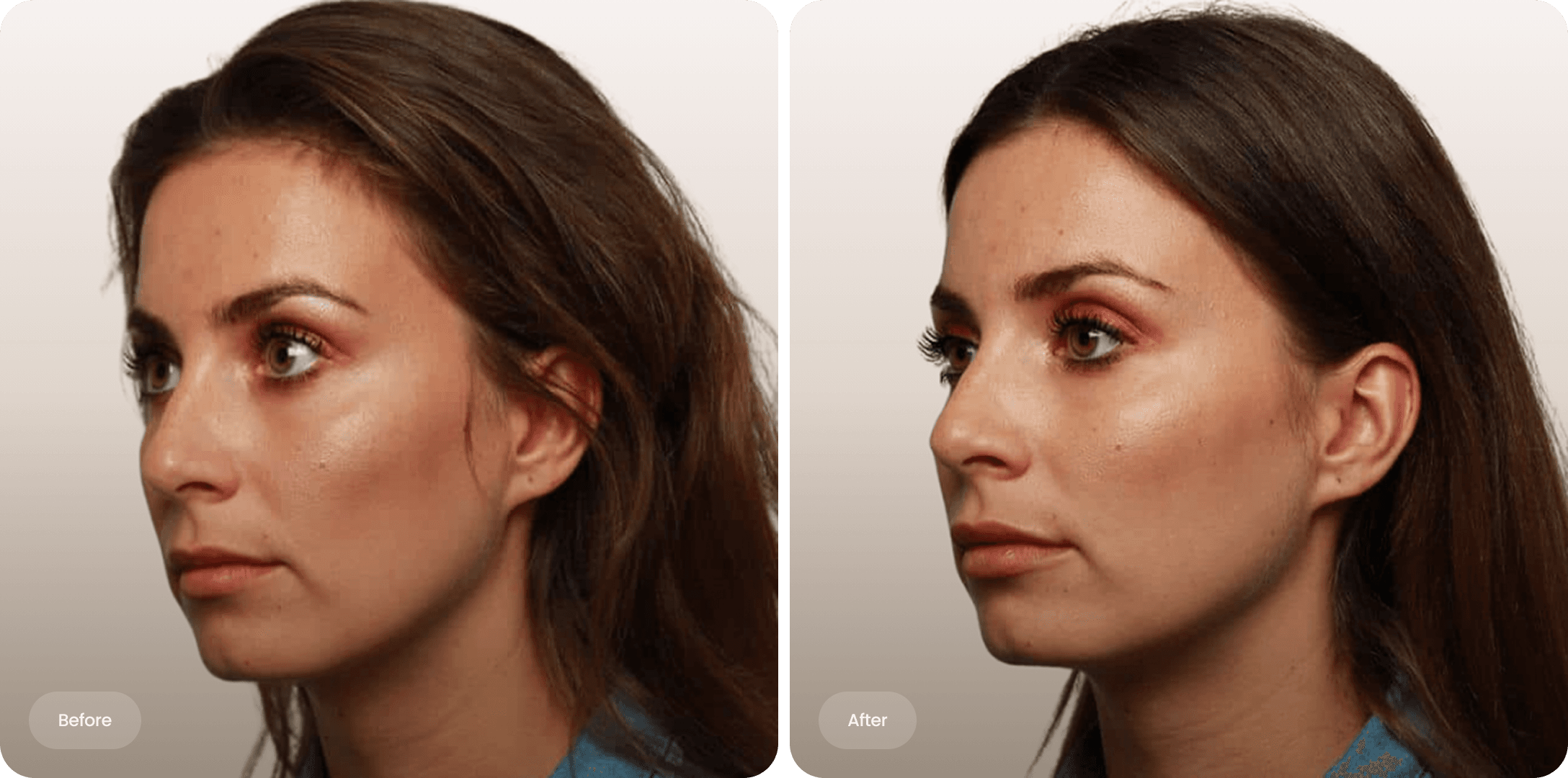 Before and after photo of lip filler treatment for a woman for natural enhancement at The Body Clinic