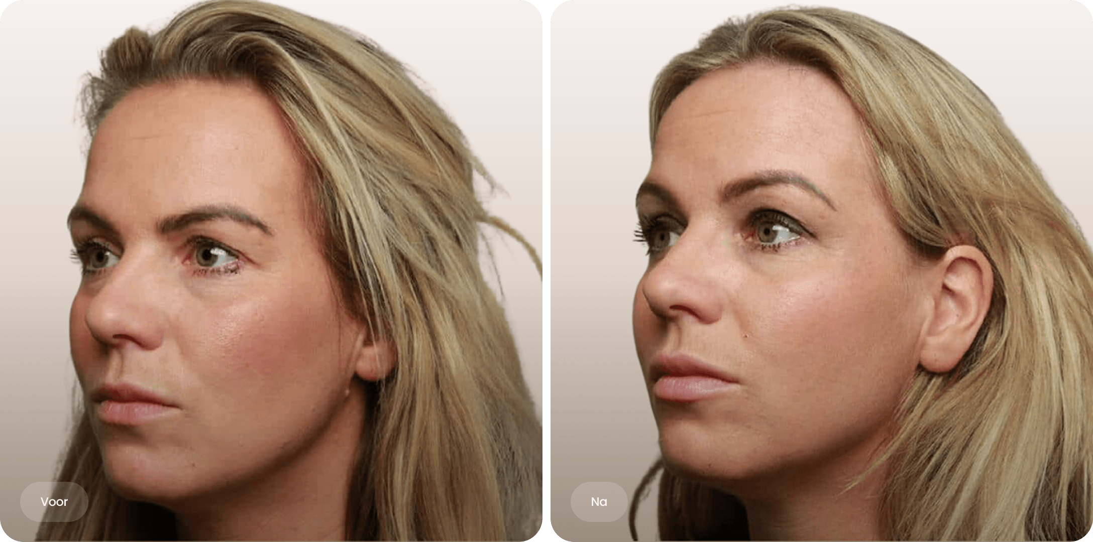 Side profile before and after comparison of a woman with improved jawline and neck tightness.