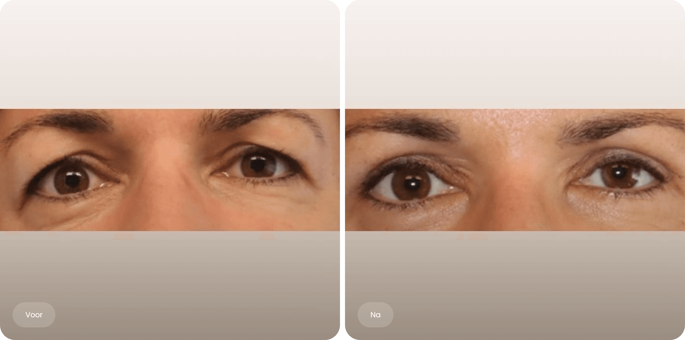 Voor en na foto van een bovenooglidcorrectie bij The Body Clinic