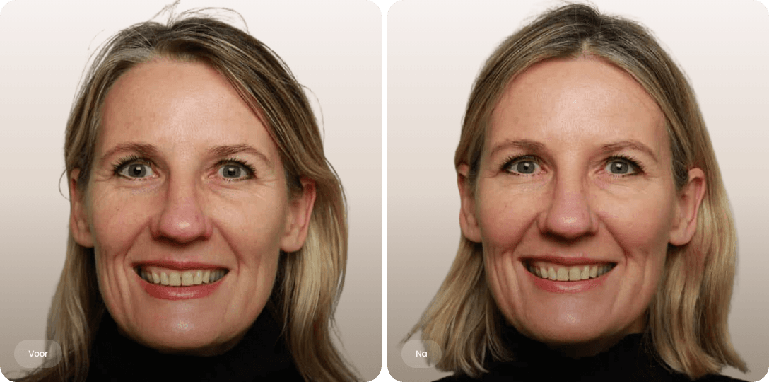 Voor en na foto van botoxbehandeling kraaienpootjes bij een vrouw voor gladdere ooghoeken bij The Body Clinic